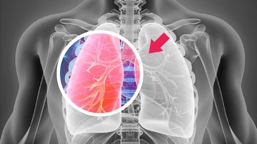 Akciğer kanserinin tedavisi mümkün müdür?