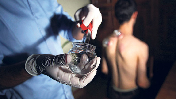 Hükümetten sağlıkta yeni hamle: Hacamat SGK kapsamında!