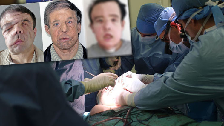 Dünyada bir ilk! Aynı kişiye iki kez yüz nakli yapıldı, işte son hali