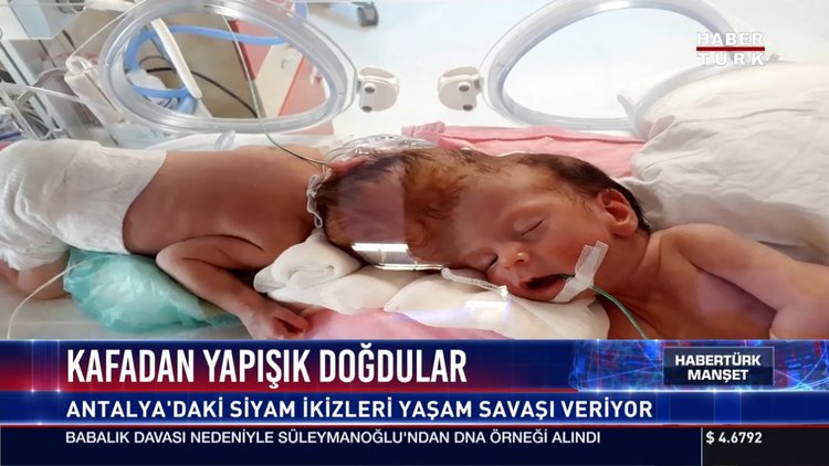 Siyam ikizlerinin yaşam savaşı