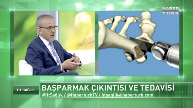 Başparmak çıkıntısı nasıl tedavi edilir?
