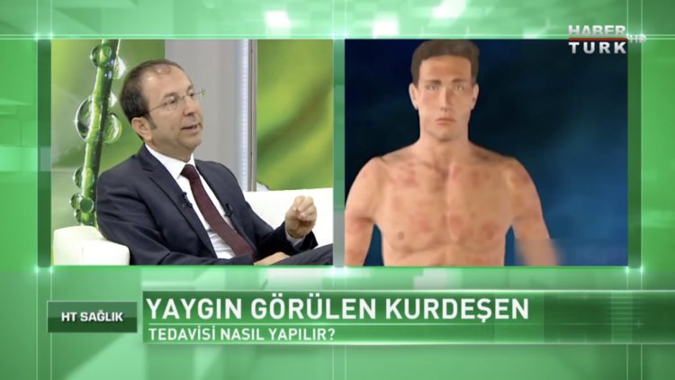 Kurdeşen tedavisi nasıl yapılır?
