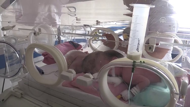 Siyam ikizlerinin biri "Yiğit" diğeri "Derman"