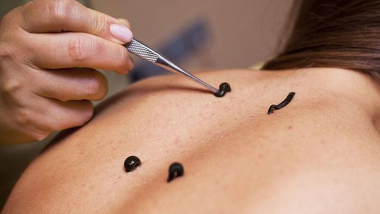 Geleneksel tıbba ilgi arttı! Uzmanlar uyardı: Hekimsiz uygulamalar Acil&#039;de bitebilir