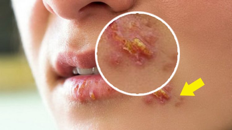 Uçuk varken bunları sakın yapmayın!