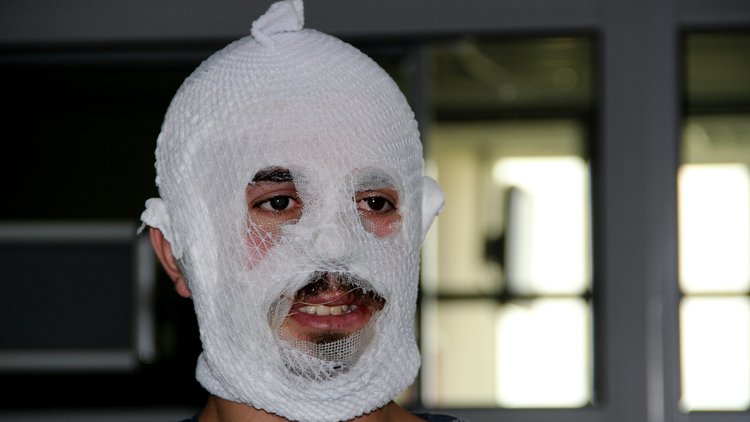 Krem yüzünü bu hale getirdi! Tüm derisi soyuldu