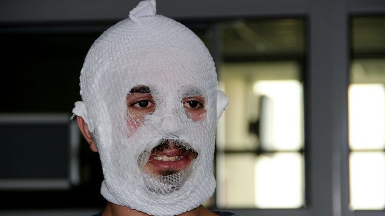 Merdiven altı krem yüzünü yaktı