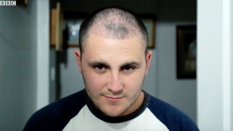 Türkiye'de saç ekimi: Bir İngiliz'in kellikle mücadele yolculuğu