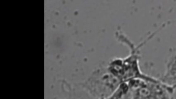 Türk hekimlerden karaciğer kanserinin teşhisinde devrim olacak çalışma