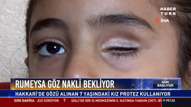 Rumeysa göz nakli bekliyor: Hakkari'de gözü alınan 7 yaşındaki kız protez kullanıyor
