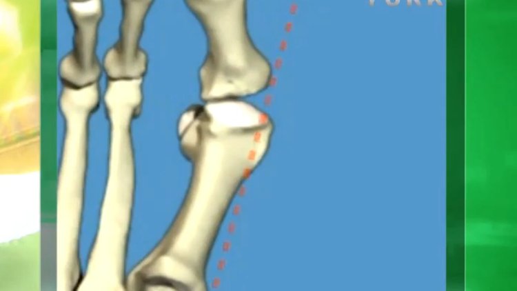 Başparmak çıkıntısı tedavisi nasıl olur?