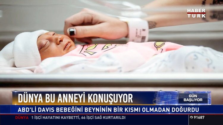 Dünya bu anneyi konuşuyor: ABD'li Davis bebeğini beyninin bir kısmı olmadan doğurdu