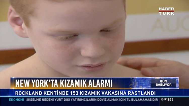 New York'ta kızamık alarmı: Rockland kentinde 153 kızamık vakasına rastlandı