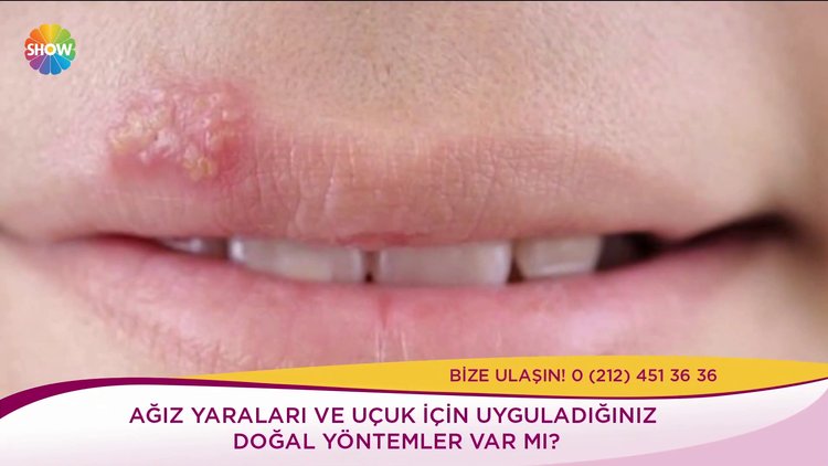 Ağız yaraları için ne kullanılır?