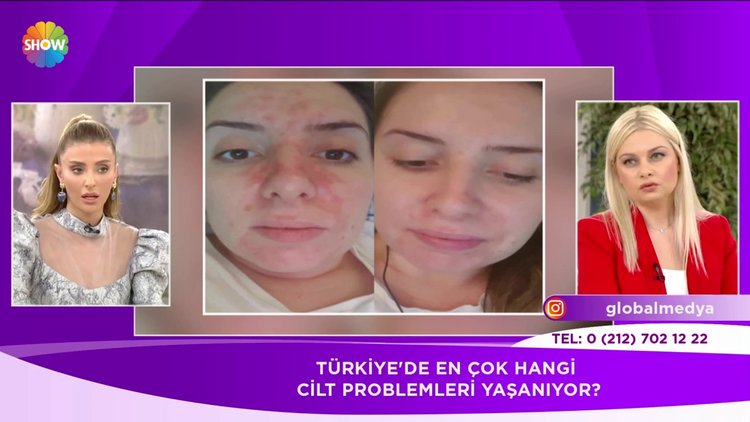Türkiye'de en çok hangi cilt problemiyle karşılaşılıyor?