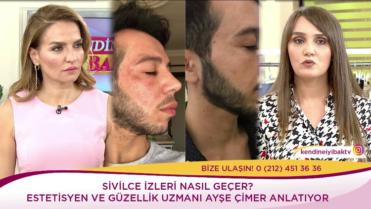 Cilt lekeleri için neler yapılmalı?