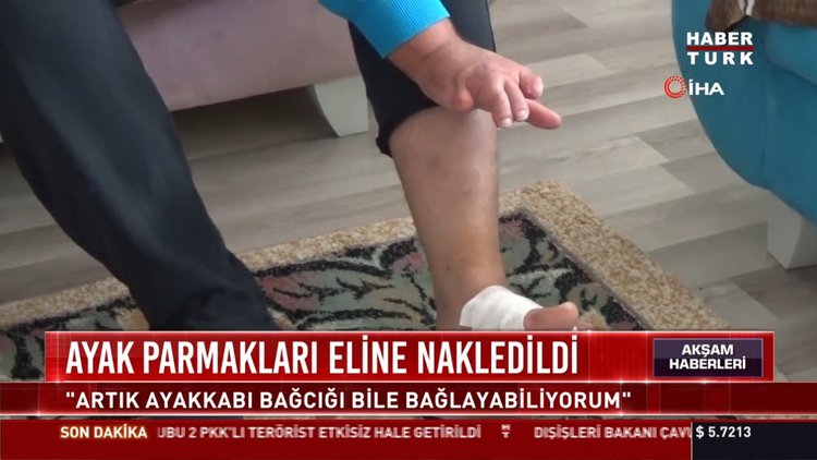 Ayak parmakları eline nakledildi