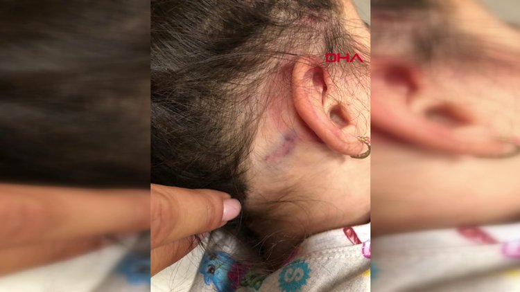 2,5 yaşındaki kız çocuğu, anaokulunda yaşıtları tarafından dövüldü