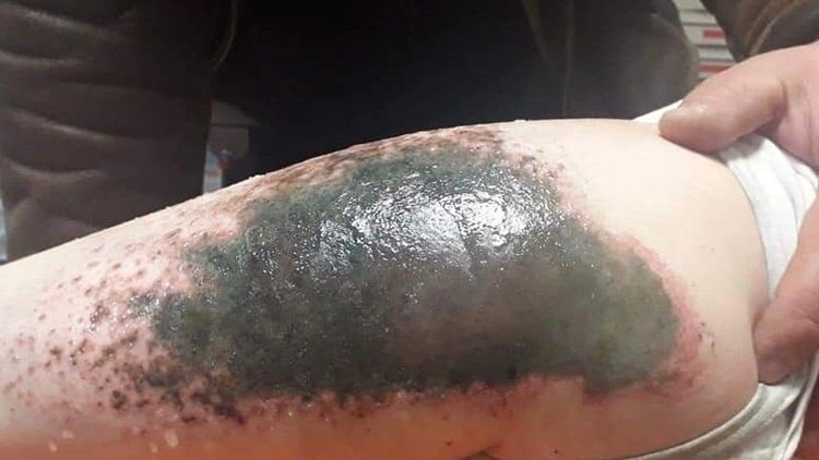 Kar topu oynayan çocukların vücudu neden yandı?