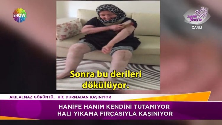 Hiç durmadan kaşınan Hanife Hanım'ın hastalığı ne?