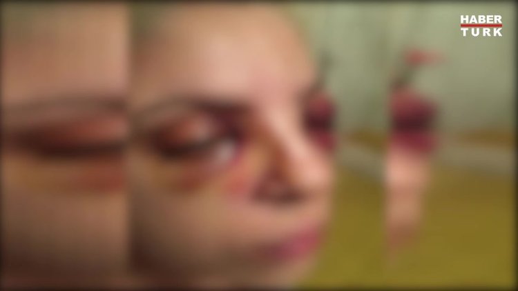 Şizofreni hastasının gözlerini oymaya çalıştığı Burcu, saldırıyı anlattı