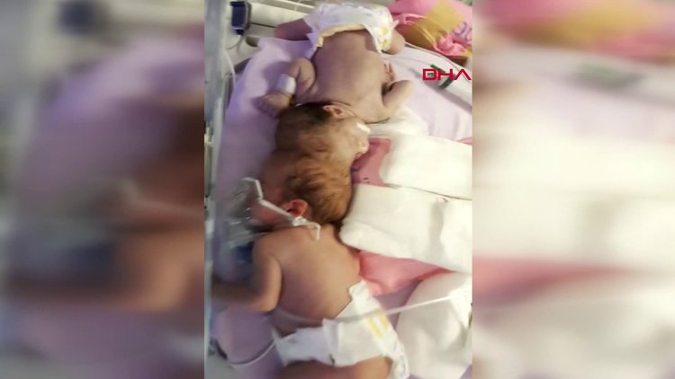 Antalyalı siyam ikizleri İngiltere'de ayrıldı