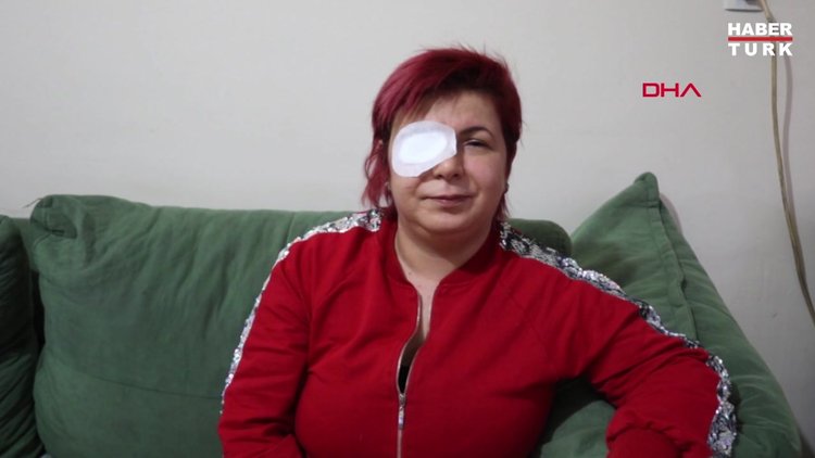 Alerji olan kadının derisi döküldü, sağ gözü görme kaybı yaşadı