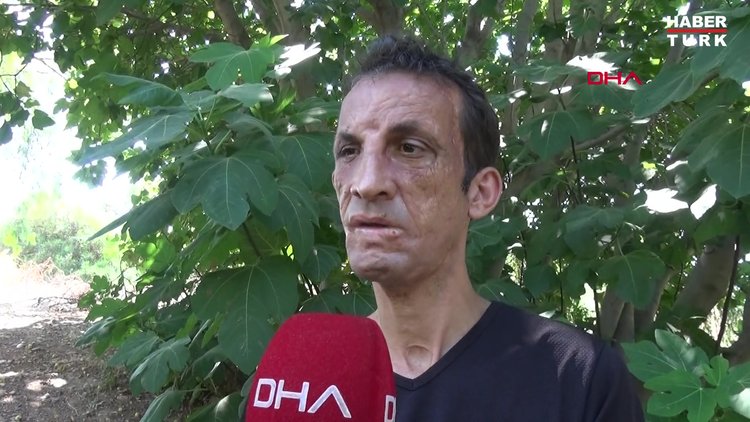 Türkiye'nin ilk yüz nakillisi Uğur Acar: Önce yüzüm şimdi de anılarım yandı