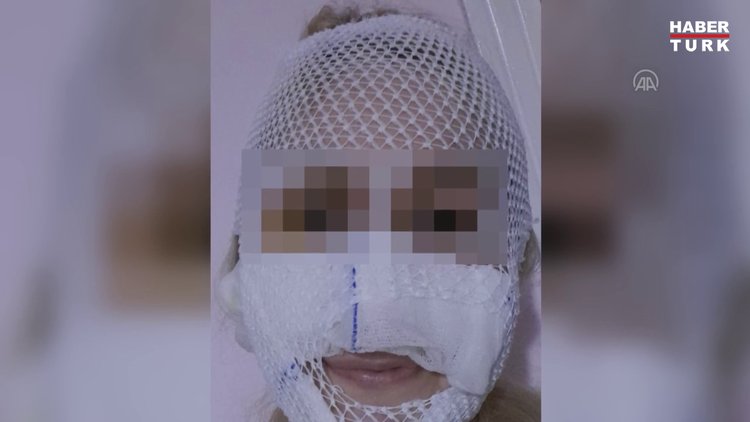 Yüzüne kimyasal madde atılan şiddet mağduru kadın, yaşadıklarını anlattı