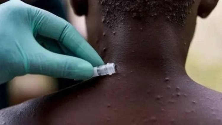 Maymun Çiçeği - Monkeypox Türkiye'de var mı?