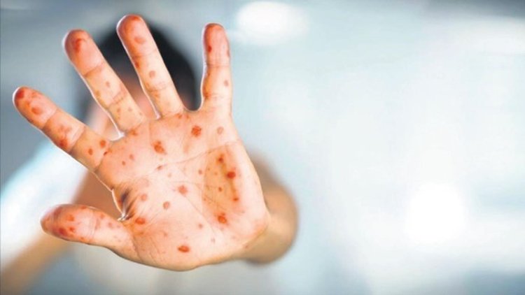 Türkiye'de ilk maymun çiçeği vakası görüldü