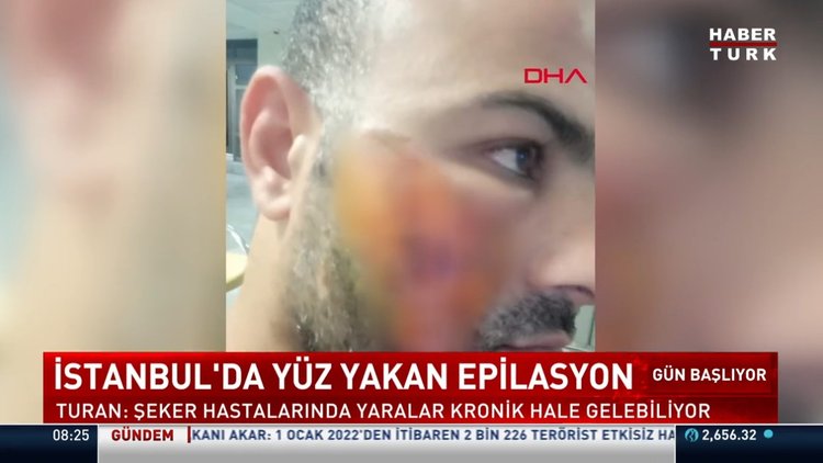 İstanbul'da yüz yakan epilasyon
