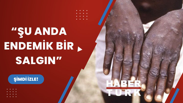 Maymun çiçeği salgınında son durum ne?