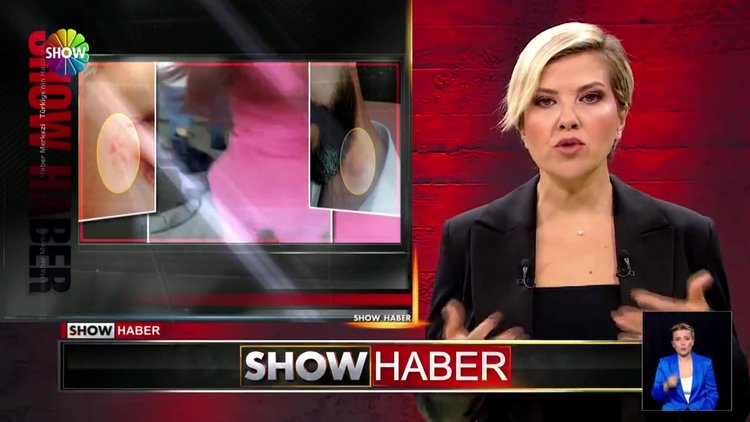 Lazer epilasyon kabusu!