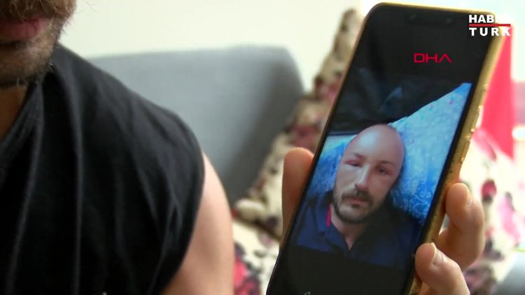 2 gün plaja gitti, başında nadir görülen sıcak ödemi oluştu