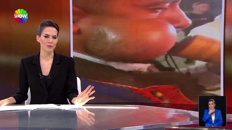 Yanakları balon gibi şişti!