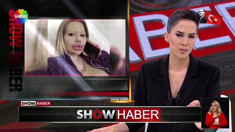 Dünyanın en büyük dudaklı kadını