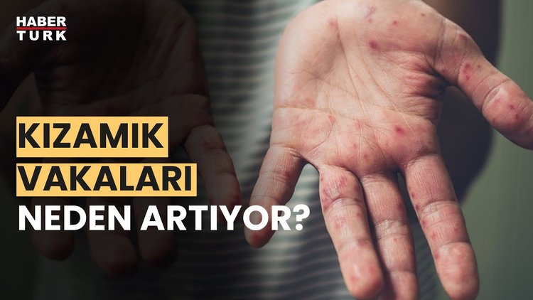 İstanbul&#039;da Kızamık Salgını mı var? Prof. Dr. Mehmet Ceyhan yanıtladı