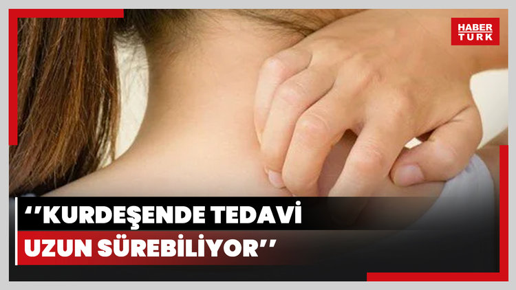 Kurdeşende tedavi uzun sürebiliyor