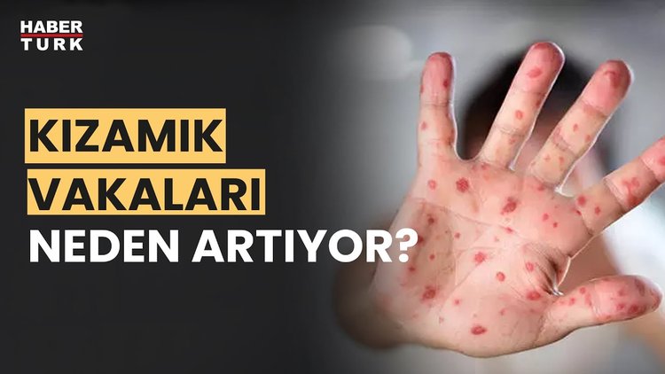 Kızamık salgını tehlikesi var mı? Prof. Dr. Mehmet Ceyhan yanıtladı