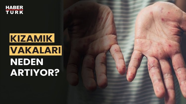 Kızamık vakaları salgına dönüşür mü? Prof. Dr. Mehmet Ceyhan yanıtladı