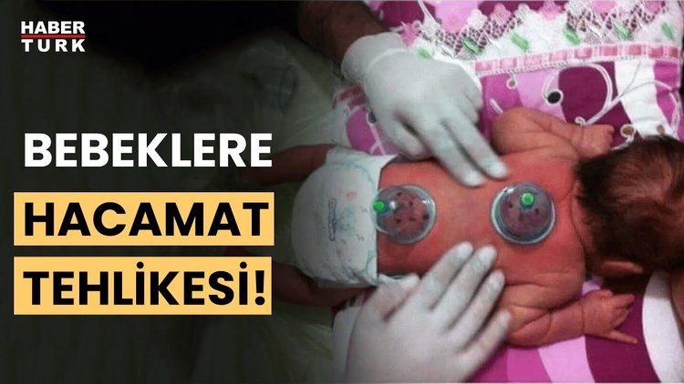 Sosyal medyada yeni furya: Bebeklere hacamat yapıyorlar