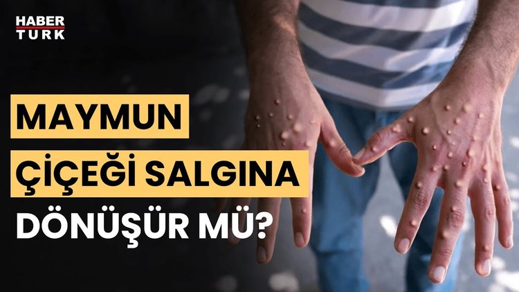 Türkiye&#039;de maymun çiçeği riski var mı? Prof. Dr. Önder Ergönül değerlendirdi