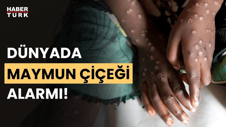 Maymun Çiçeği ne kadar bulaşıcı? Oğuz Özyaral yanıtladı