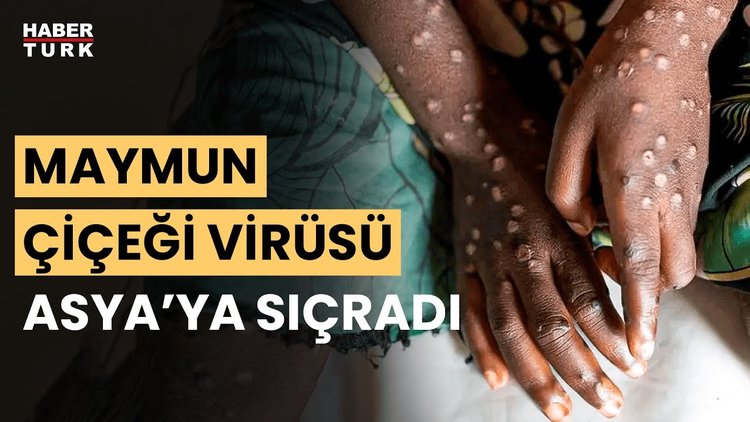 Maymun çiçeği virüsü yayılıyor! Filipinler&#039;de bir kişide maymun çiçeği virüsü tespit edildi!