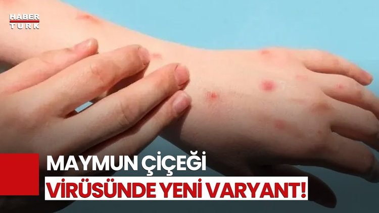 Maymun Çiçeği Virüsü Yayılıyor!