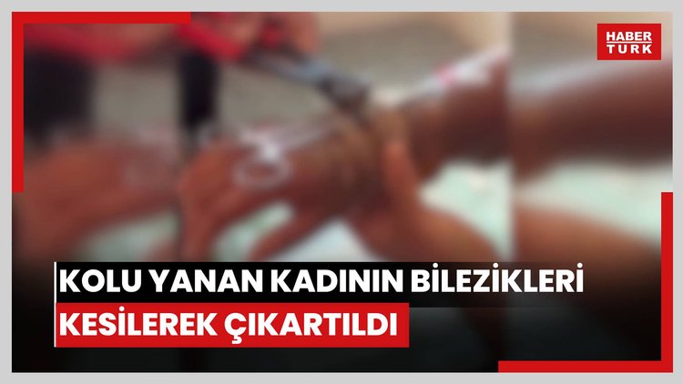Kolu yanan kadının bilezikleri kesilerek çıkartıldı