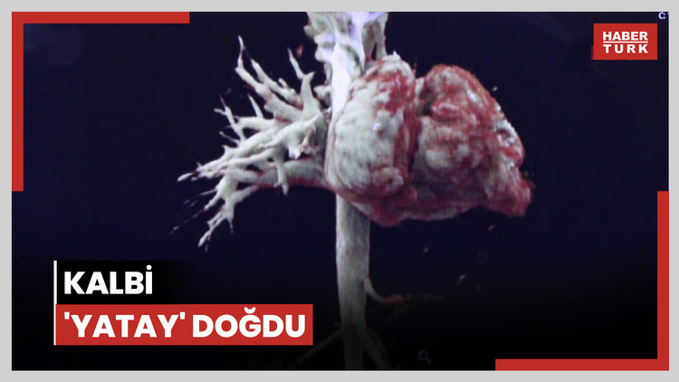 Kalbi 'yatay' doğdu, Türkiye'de ilk kez yapılan ameliyatla sağlık buldu