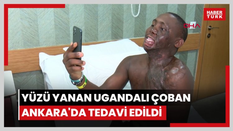 Yüzü yanan Ugandalı çoban Ankara'da tedavi edildi