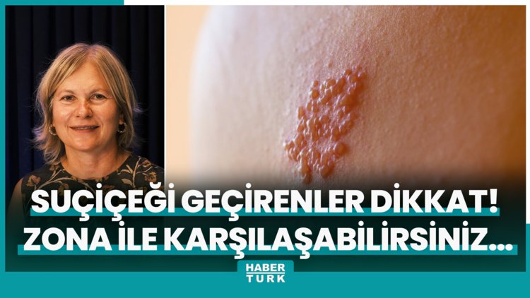 Küçükken suçiçeği geçirenler dikkat! Her an zona ile karşılaşabilirsiniz…